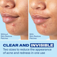 Thumbnail for Image 5 of Differin Power Pimple Patches, Hydrocolloid Acne Treatment, 23ct